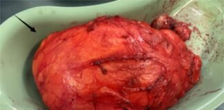 China Medical Team’s Breakthrough Breast Surgery Relieves Patient and Restores Confidence