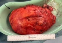 China Medical Team’s Breakthrough Breast Surgery Relieves Patient and Restores Confidence